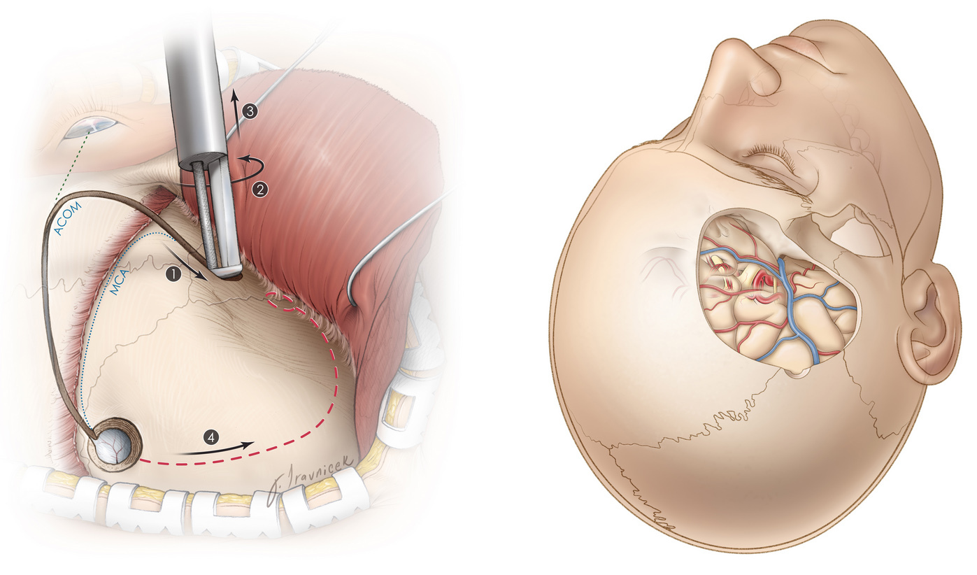 Craniotomy Surgery